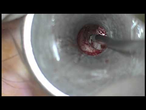 how to cure otosclerosis