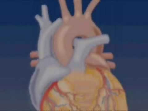 Coarcatation of the Aorta