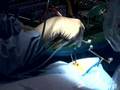Live webcast: No incision surgery for pituitary brain tumor