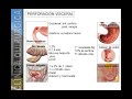 ABDOMEN AGUDO PERFORATIVO 1