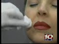 Restylane and Juvederm Wrinkle Treatment