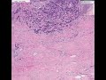 Histopathology Breast --Ductal carcinoma