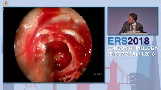 ERS London 2018, New Technologies in Skull Base, Christos Georgalas