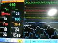 Electrocardiogram,ICU