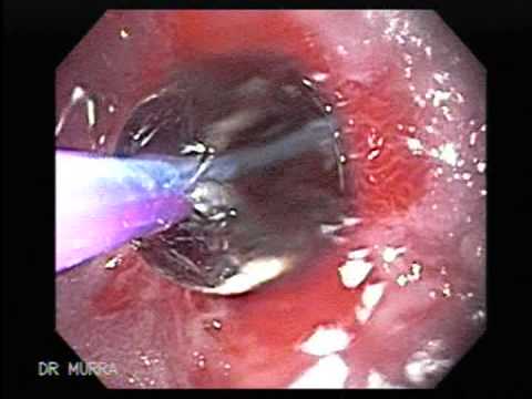 how to relieve dysphagia