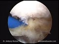 From Open to Arthroscopic Rotator Cuff Repair with Anthony A. Romeo, M.D., Part 3 From Open to Arthroscopic Rotator Cuff Repair with Anthony A. Romeo, M.D., Part 3