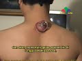 The Sunnah of Hijaamah (cupping/bekam) - part 2