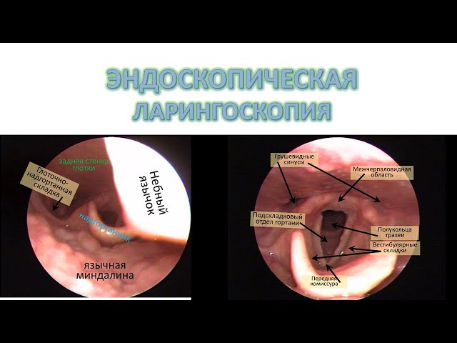 ЭНДОСКОПИЧЕСКАЯ ЛАРИНГОСКОПИЯ НОРМА