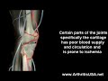 Knee pain due to Osteochondritis Dissecans by Dr Farshchian