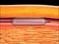 Generic Balloon Angioplasty Animation