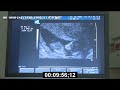 HD Ultrasound - Baby - HD Stock Footage - HD Stock Videos - HD Stock Video - HD Medical - HD Exam