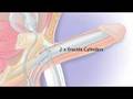 Erectile Dysfunction, Penile Prosthesis and Prostate Cancer