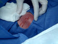 Abscess lanced