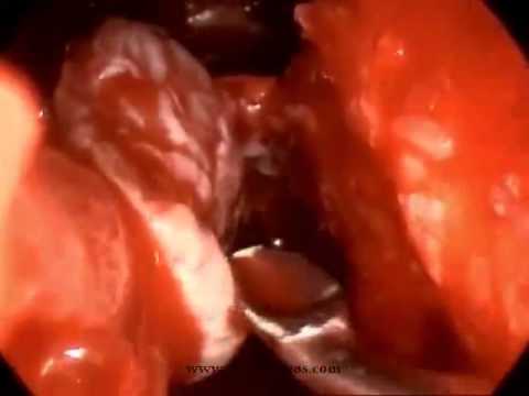 how to identify csf leak