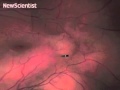 Drug-carrying robot roams through eye