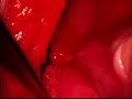 Tubal anastomosis