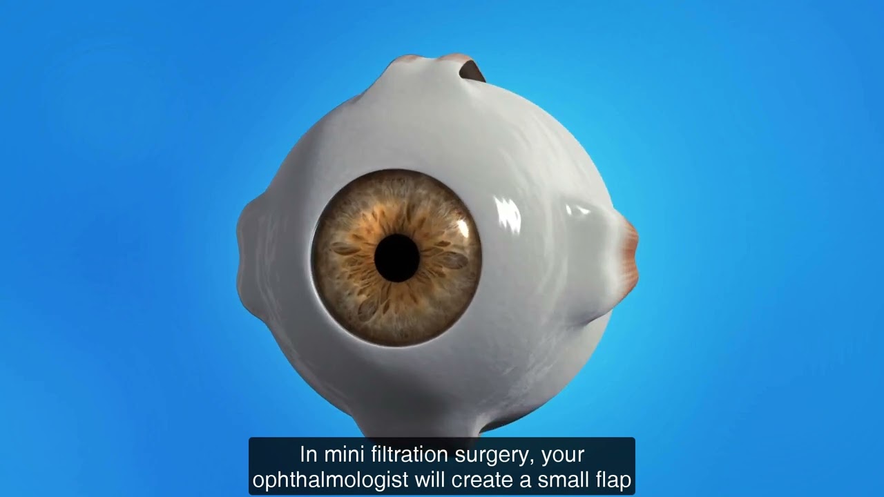 Glaucoma Mini Filtration Implants