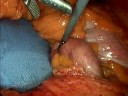 Removal of Another Failed Adjustable \"Lap\" Band Removal of Another Failed Adjustable \"Lap\" Band