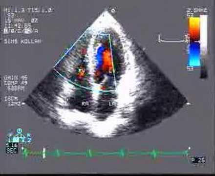 Increased flow velocity across moderator band