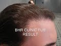 BHR Clinic 4022 FUE Hair Line Repair
