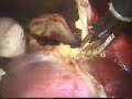 Laparoscopic Management of Liver Hydatid Disease