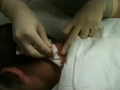 Cremins sebaceous cyst