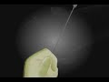 medical womb filter concept medical womb filter concept
