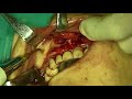 implant dental video preview 17
