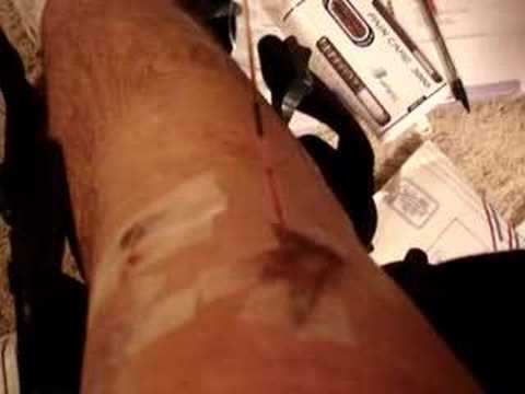 hemovac