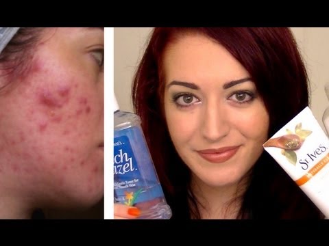 UPDATED! MY FAVORITE DRUGSTORE ACNE PRODUCTS! Simple, Cheap Skin Care & Acne Treatments! AQA#2