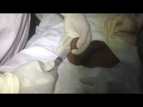 how to cure azoospermia by medicine