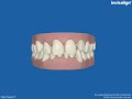 overbite & crooked teeth fixed with Invisalign (Invisaline) in Los Altos, CA