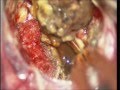 Brain cavernous angioma-microsurgical excission-dr suresh dugani/HUBLI/KARNATAK/INDIA