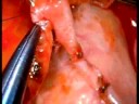 beating heart surgery T graft