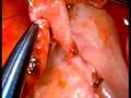 beating heart surgery T graft