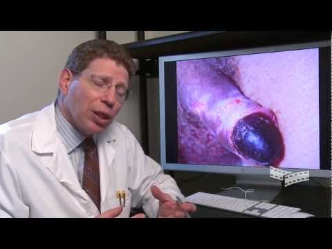penectomy