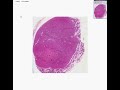 Histopathology Parathyroid--Oxyphil adenoma Histopathology Parathyroid--Oxyphil adenoma