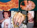 Medical School Pathology, Chapter 4d Medical School Pathology, Chapter 4d