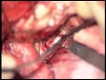 Surgical approach for anterior cominican artery aneurysm