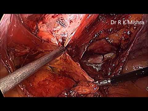how to repair abdominal fascia