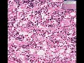 Histopathology Bone marrow--Erythroid hyperplasia