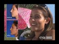 Nose Surgery, Rhinoplsty, Dr. Cruise Nose Surgery, Rhinoplsty, Dr. Cruise