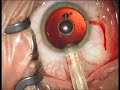Visian ICL implantation CASE 3, Hycl Lexum Visian ICL implantation CASE 3, Hycl Lexum