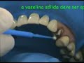 Provis�ria com matriz de silicona