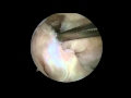 Posterior Cruciate Ligament Correction Using Remnant Augumentation Technique