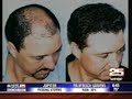 Genetic Baldness Test _ ABC NEWS Palm Beach Genetic Baldness Test _ ABC NEWS Palm Beach