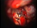 Brain Aneurysm