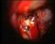 Brain Aneurysm