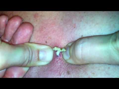 gross - not really sure what this thing really is, it was extremely hard to pop we had to squeeze very hard...it's been on his back for about 10 years, it was about ...