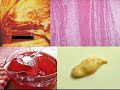 Medical School Pathology, Chapter 4i Medical School Pathology, Chapter 4i